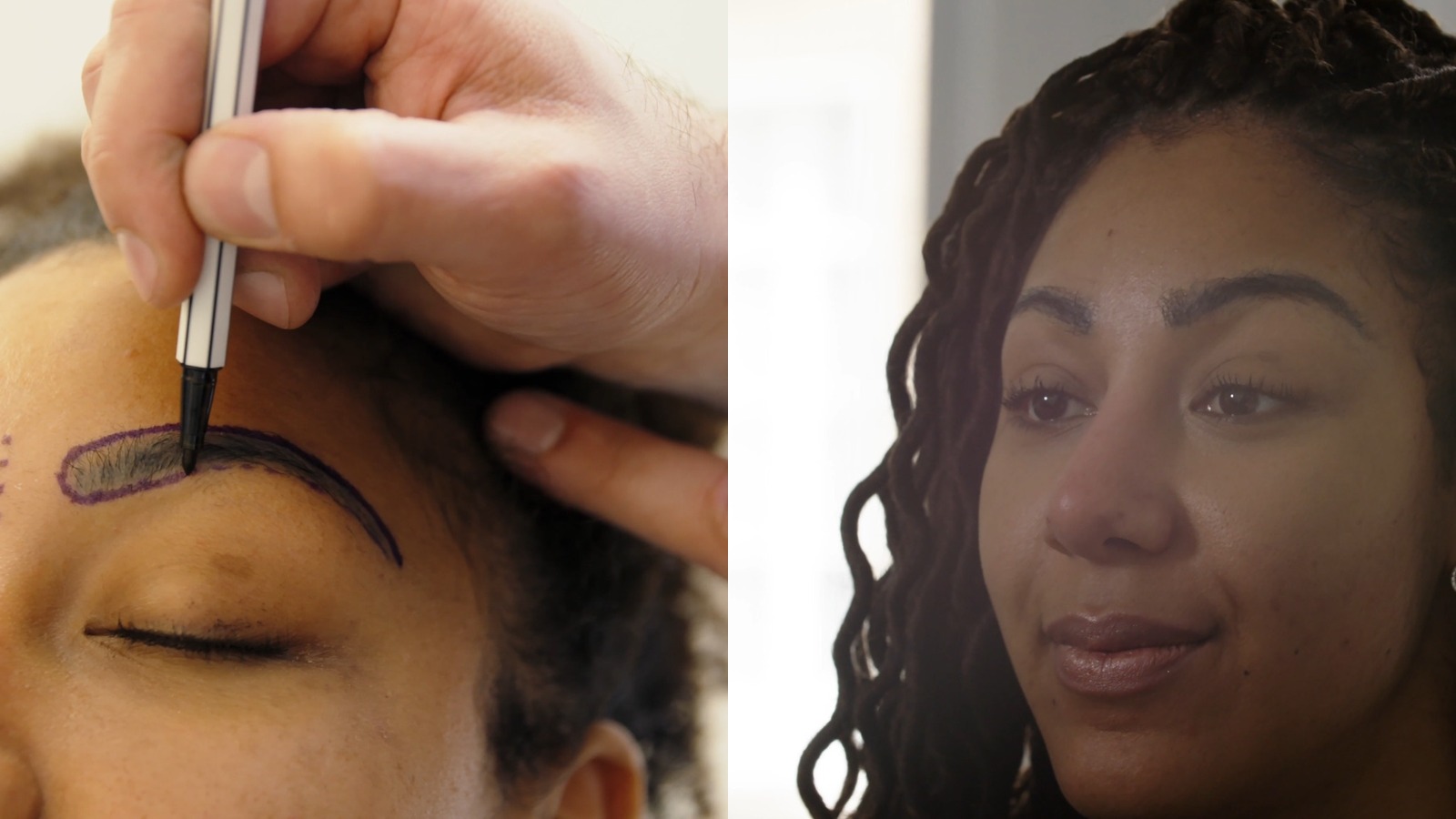 Chloe before and after eyebrow transplant