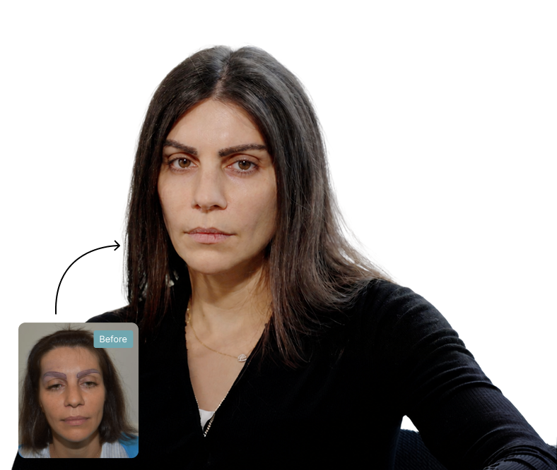 Nadia before and after eyebrow transplant