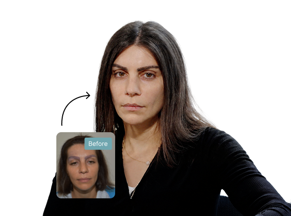 Nadia before and after eyebrow transplant
