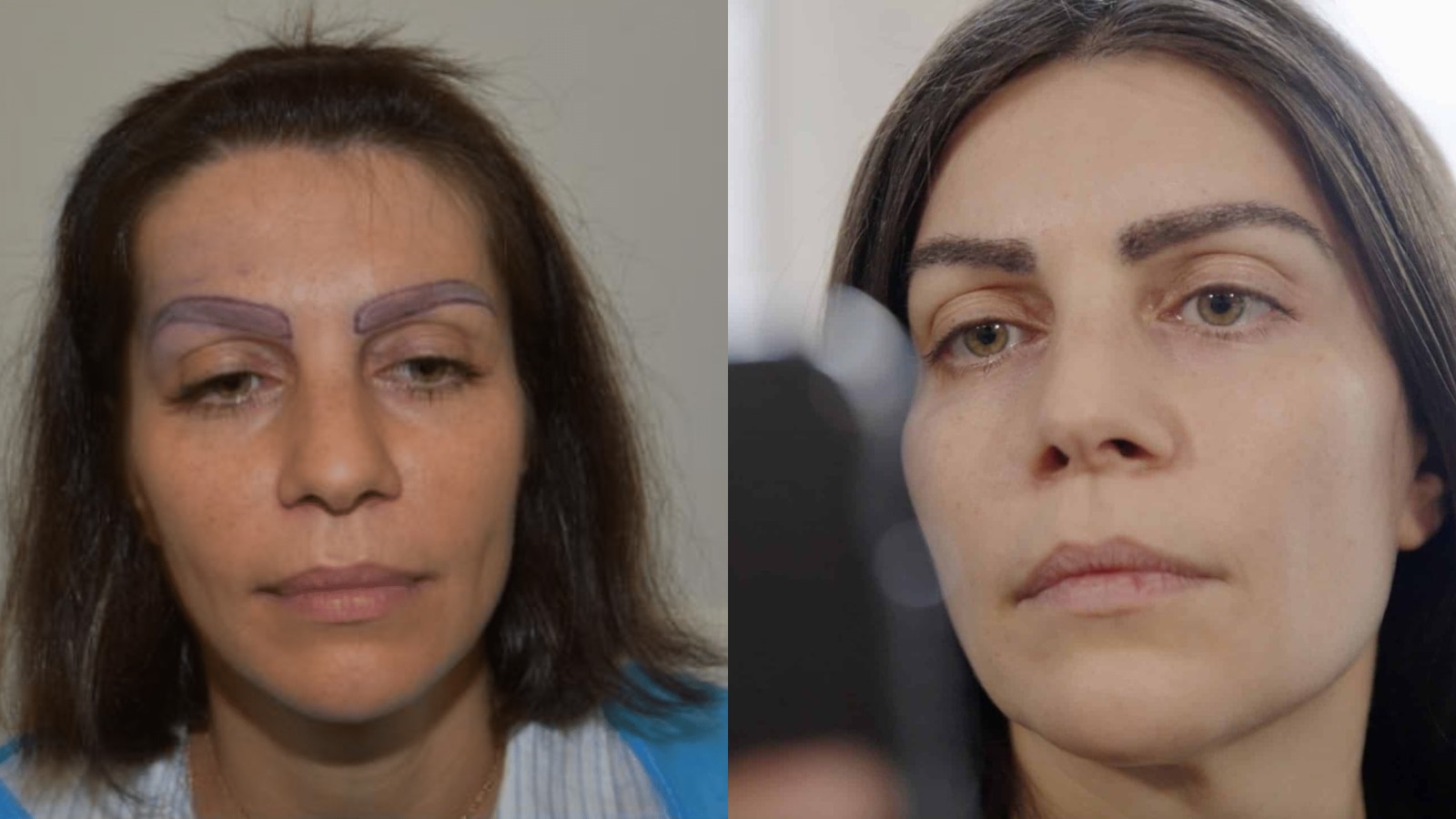 Nadia before and after eyebrow transplant