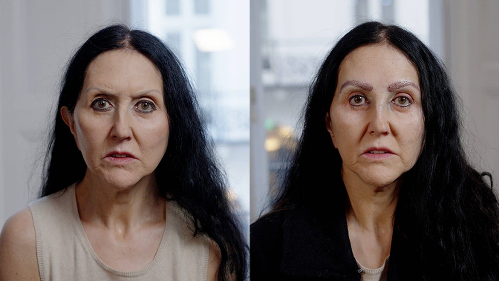 Liz before and after eyebrow transplant